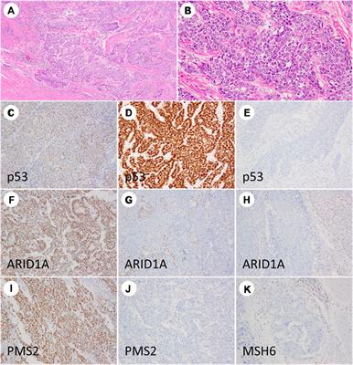 Loss of ARID1A Expression as a Favorable Prognostic Factor in Early-Stage Grade 3 Endometrioid Endometrial Carcinoma Patients